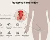 Ilustracja pokazuje przyczyny hemoroidów, w tym ciążę, wysiłek fizyczny, zaparcia, nieprawidłowe odżywianie, siedzący tryb życia i seks analny. Czy hemoroidy są groźne?