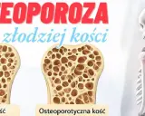 Osteoporoza to nie rak kości, lecz cichy złodziej kości. Porównanie zdrowej i osteoporotycznej kości.