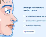 Nadczynność tarczycy objawy: wytrzeszczone oczy (1), przetłuszczone włosy (2) i wzmożona potliwość (3) na twarzy.