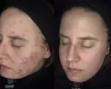 Przed i po: widoczna poprawa cery z trądzikiem, co sugeruje skuteczne metody, jak obniżyć DHT.