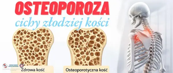 Osteoporoza to nie rak kości, lecz cichy złodziej kości. Porównanie zdrowej i osteoporotycznej kości.